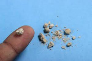 http://dr-vahidi.com › علائم-سنگ-ک... Translate this page علائم سنگ کلیه. سنگ های کلیه به تجمعات سفت و سختی گفته می شود که از جنس نمک و مینرال ها از جمله کلسیم و اوریک اسید هستند. این سنگ ها در کلیه تشکیل می ...