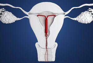 آیودی (IUD) یک دستگاه داخل رحمی هورمونی است که می تواند کنترل طولانی مدت بارداری (پیشگیری از بارداری) را فراهم کند.
