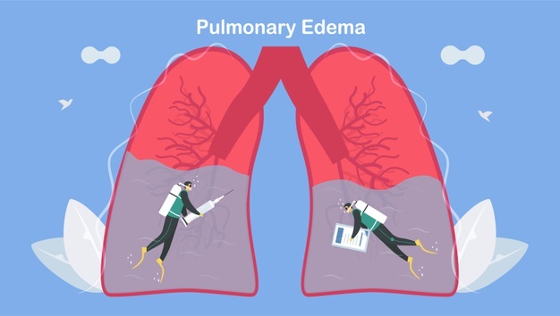 ادم ریوی بیماری است که در اثر مایعات اضافی در ریه ها ایجاد می شود. این مایعات در کیسه های هوایی متعدد ریه جمع می شود و تنفس را دشوار می کند.