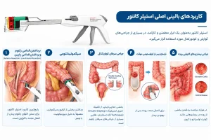استپلر کانتور در جراحی