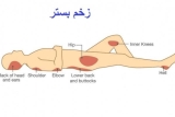 زخم بستر چیست؟