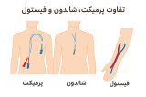 تفاوت پرمیکت (Permcath)، شالدون (Shaldon) و فیستول (AVF – Arteriovenous Fistula)