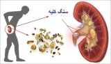 سنگ کلیه چیست؟علائم و درمان آن چگونه است؟