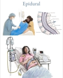 هر آنچه در مورد اپیدورال در حین زایمان باید بدانید