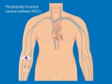 کاتتر محیطی – مرکزی PICC چیست؟ نحوه گذاشتن PICC