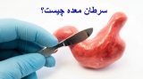سرطان معده چیست؟علائم,تشخیص,درمان آن چگونه است؟