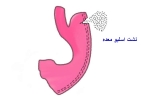 علائم نشت اسلیو معده
