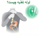 لوله تغذیه چیست؟ نحوه گذاشتن و برداشتن آن چگونه است؟